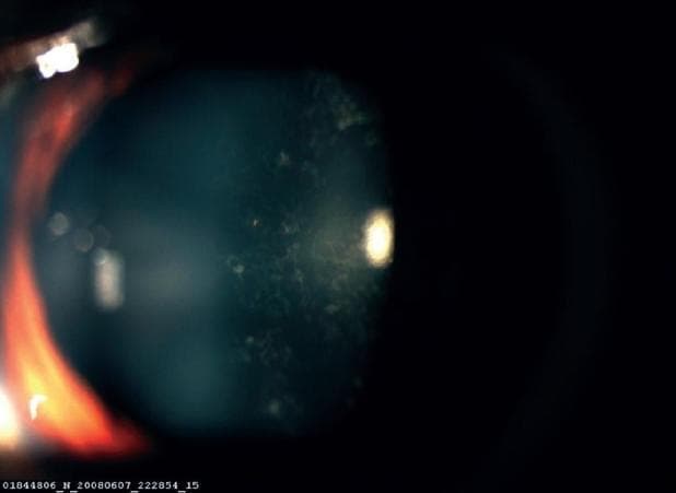 This clinical photograph displays a slit-lamp examination of a human eye, specifically focusing on the crystalline lens. The image demonstrates a posterior subcapsular cataract (PSC) characterized by granular, plaque-like opacities located in the posterior cortex of the lens, just internal to the posterior capsule. The opacities exhibit a breadcrumb or cloud-like morphology, clustered primarily in the central visual axis. A prominent light reflex is visible on the iris and anterior chamber on the left side of the frame, indicating the illumination source, while a bright, focal reflection is seen over the central opacified area of the lens. The periphery of the lens remains relatively clear compared to the densely opacified central posterior region. This finding is clinically significant as PSCs typically cause significant glare and disproportionate vision loss under bright light conditions. In this specific clinical context, the cataract is associated with ocular trauma following a lightning strike.