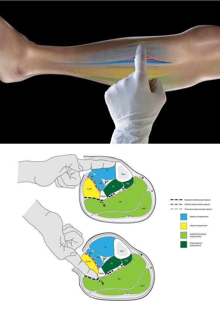 This educational graphic consists of a clinical photograph and two anatomical cross-sections illustrating the surgical technique for identifying leg compartments during a fasciotomy. The top photograph shows a gloved surgeon's finger inserted into an incision in the lower leg's fascia to palpate internal structures. Below, two schematic transverse cross-sections of the mid-leg categorize the four compartments: anterior (blue), lateral (yellow), superficial posterior (light green), and deep posterior (dark green). The top diagram demonstrates the 'tibia test': the finger enters the anterior compartment and palpates the medial tibia to confirm correct localization. The bottom diagram demonstrates the identification of the lateral (peroneal) compartment by palpating the fibula. The diagrams highlight the role of the intermuscular septa (anterior, posterior, and transverse) as physical barriers that prevent cross-compartment palpation, serving as a vital intraoperative check to ensure all compartments are adequately decompressed in cases of acute compartment syndrome.