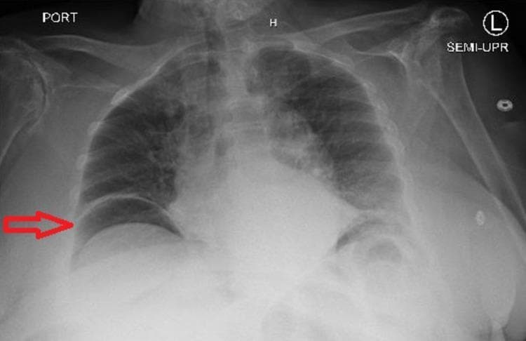 A semi-upright anteroposterior (AP) chest X-ray demonstrating a large pneumoperitoneum. The primary diagnostic finding is a crescent-shaped radiolucency (free air) located subdiaphragmatically under the right dome of the diaphragm, highlighted by a red arrow. This free air clearly silhouettes the superior margin of the diaphragm and separates it from the underlying liver shadow. The left hemidiaphragm is also visible, with underlying gastric bubble and potentially additional free gas. The lung fields are relatively clear without focal consolidation or pleural effusion. The cardiac silhouette is within normal limits for this projection, though the AP view limits precise assessment of cardiothoracic ratio. Bony structures including the ribs and clavicles appear intact. This classic radiographic sign, known as the cupola sign or subdiaphragmatic free air, is a surgical emergency highly suggestive of a perforated viscus (e.g., perforated peptic ulcer or diverticulitis).
