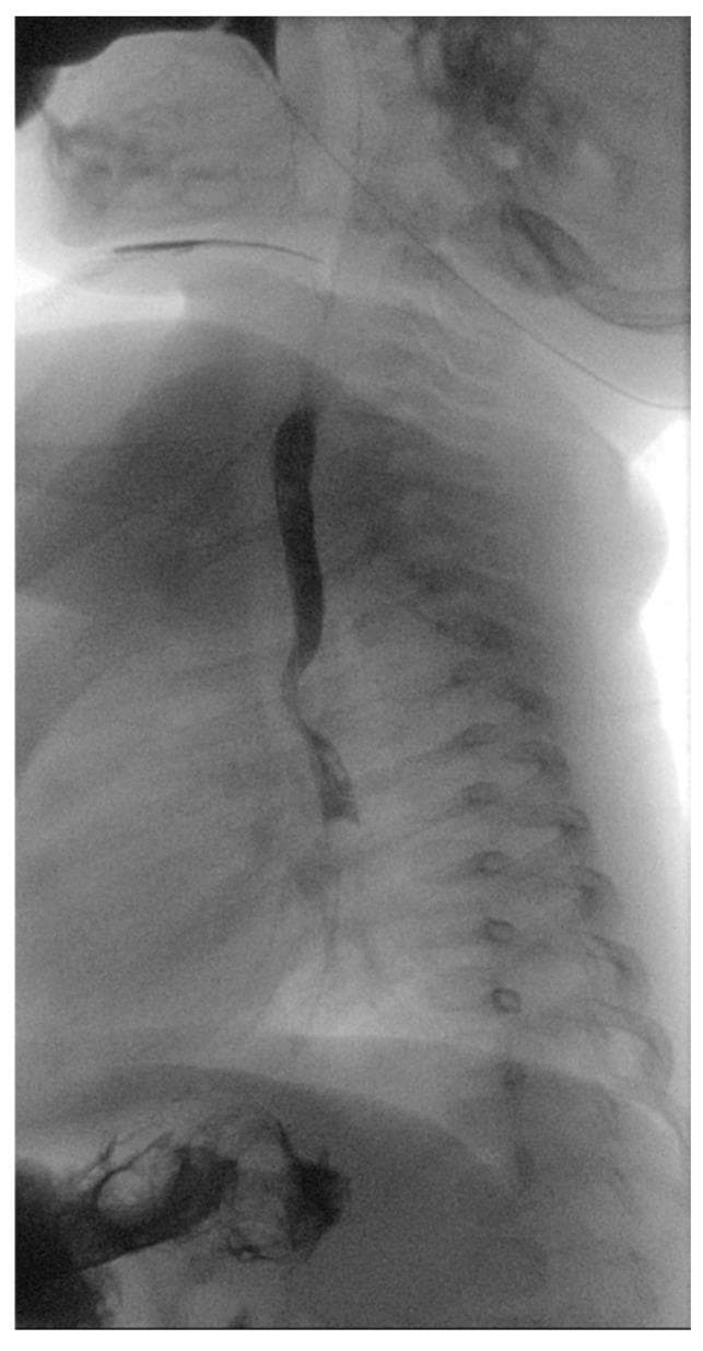 This lateral-view diagnostic image demonstrates a pediatric barium swallow test (contrast esophagram) in a 5-month-old patient. The esophagus is opacified with contrast, appearing as a dark, vertical column against the radiolucent thoracic cavity and the radiopaque vertebral column. A significant pathological finding is visible in the proximal thoracic region: a focal posterior indentation of the esophageal wall. This indentation causes localized narrowing of the contrast column and anterior displacement, which is a classic radiographic sign of extrinsic compression. In the clinical context of dysphagia and failure to thrive, such a finding is highly suggestive of a vascular ring, such as a right aortic arch with an aberrant left subclavian artery and Kommerell's diverticulum. The remainder of the esophagus distal to the compression appears to have a normal caliber. This image serves as a critical diagnostic step in pediatric radiology for identifying congenital anatomical anomalies affecting the upper gastrointestinal tract.