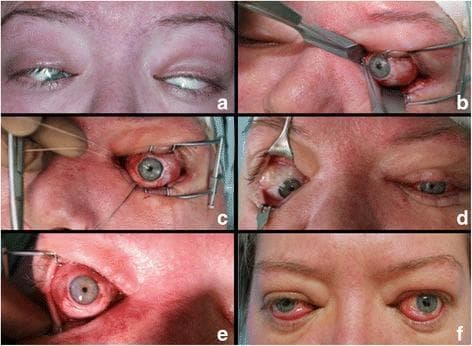This composite of clinical photographs documents the surgical management of severe restrictive strabismus in a patient with Graves' ophthalmopathy. Panel (a) shows the preoperative presentation of extreme bilateral esotropia and hypotropia, with significant globe deviation and restricted visibility of the pupils. Panels (b), (c), and (e) illustrate intraoperative stages of extraocular muscle release and recession. Specifically, (b) displays the identification and isolation of the inferior rectus muscle using a squint hook through a transconjunctival approach. Panel (c) shows the globe in a corrected primary position after the release of the inferior and medial rectus muscles, with non-absorbable sutures and a speculum visible. Panel (d) demonstrates the asymmetrical interim results one week after surgery on the left eye only. Finally, panel (f) depicts the three-month postoperative outcome, showing restored vertical and horizontal primary alignment in both eyes, despite mild persistent exophthalmos and conjunctival hyperemia. This sequence highlights the effectiveness of extraocular muscle repositioning for correcting fixed globe deviation in advanced autoimmune thyroid eye disease.