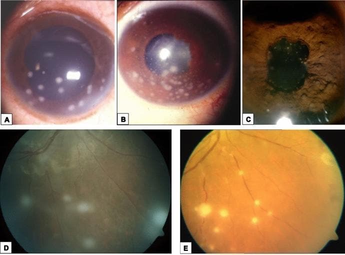 This composite of clinical ophthalmic photographs illustrates the ocular manifestations of systemic sarcoidosis across different anatomical segments. Panels (a), (b), and (c) are slit-lamp photographs of the anterior segment. Panels (a) and (b) demonstrate granulomatous anterior uveitis, characterized by mutton-fat keratic precipitates (large, greasy-appearing inflammatory deposits on the corneal endothelium). Panel (c) shows the iris stroma featuring multiple Busacca nodules, which are inflammatory granulomas located away from the pupillary margin. Panels (d) and (e) are fundus photographs demonstrating posterior segment involvement. Panel (d) illustrates intermediate uveitis with 'snowball' opacities—distinct, rounded inflammatory aggregates suspended in the vitreous humor. Panel (e) depicts sarcoid retinal vasculitis, specifically segmental periphlebitis with thick, yellowish-white perivenous exudates resembling 'candle wax drippings.' This collection serves as an educational reference for identifying characteristic granulomatous inflammatory signs in the eye, which are critical for the diagnosis and classification of ocular sarcoidosis.