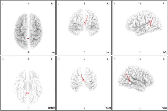 This diagnostic visualization consists of six 3D neuroimaging renderings of the human brain, illustrating functional connectivity data. The images are presented in six standard anatomical orientations: top (superior), bottom (inferior), back (posterior), front (anterior), left lateral, and right lateral views. Each view is labeled with directional markers: L (left), R (right), A (anterior), P (posterior), S (superior), and I (inferior) to maintain spatial context.
The cortical surface is depicted in light gray, showing clearly defined gyri and sulci. Superimposed on these renderings are red curvilinear lines representing statistically significant (p < .05) increased functional connections in chronic tinnitus patients. These connections, identified via lagged phase synchronization analysis, map specifically to pathways between the parahippocampus gyrus (Brodmann areas 21 and 22) and the posterior cingulate cortex (BA 18) as well as the precuneus (BA 28). The visualization demonstrates localized enhancements in functional synchronization within the medial temporal and posteromedial parietal regions associated with auditory and cognitive processing.