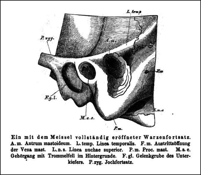 This historical anatomical illustration from an 1873 otology textbook depicts a surgical view of the lateral skull, specifically a mastoid process that has been opened using a chisel (Schwartze-type mastoidectomy). The drawing illustrates the surgical landmarks and spatial orientation required for safe access to the mastoid antrum (A.m.), which appears as a dark, funnel-shaped cavity within the bone. Key anatomical structures include: 1) The linea temporalis (L. temp.), marking the superior surgical limit; 2) The external auditory meatus (M.a.e.) with the tympanic membrane visible, situated anterior to the mastoid opening; 3) The zygomatic process (P.zyg.) and glenoid fossa (F.g.l.) located anterior-inferiorly; 4) The mastoid process (P.m.) forming the inferior border; and 5) The foramen of the mastoid vein (F.m.) and linea nuchae superior (L.n.s.) positioned posteriorly. This image serves as an educational reference for historical otological surgery and the fundamental anatomy of the temporal bone, highlighting the relationship between external surface landmarks and deeper middle ear structures.