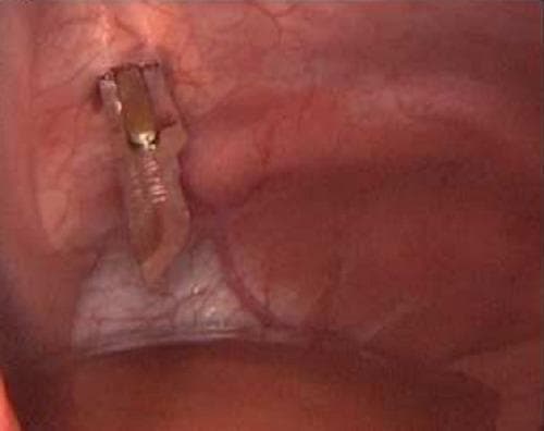 A laparoscopic clinical photograph showing a procedural view of a controlled stab incision through the internal abdominal wall. A specialized surgical instrument, identified as an ophthalmic surgical knife, is visible as it penetrates the peritoneal lining. The instrument features a metallic, silver-colored handle with ribbed texture for grip and a sharp, semi-translucent blade with a yellowish-tan hue. The surrounding anatomical field consists of the parietal peritoneum, which appears as moist, reddish-pink vascularized tissue. Fine branching subperitoneal blood vessels are clearly visible across the surgical site. The image illustrates the precise entry of a secondary trocar or instrument during a minimally invasive surgical procedure, demonstrating the relationship between the surgical tool and the abdominal wall layers.