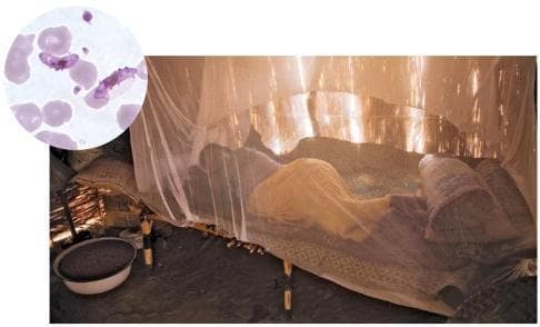 This composite educational image illustrates public health interventions and the pathophysiology of malaria. The main clinical photograph depicts a person in a rural setting in eastern Chad sleeping under a white, semi-transparent insecticide-treated bed net (ITN), a primary preventative measure against vector-borne diseases. The environment reflects a high-risk tropical region with simple housing structures. An inset diagnostic micrograph shows a Giemsa-stained thin blood smear at high magnification, highlighting Plasmodium falciparum. Visible are pale purple erythrocytes, several of which contain characteristic banana-shaped or crescentic gametocytes, diagnostic of P. falciparum infection. The visual contrast between the bedside preventative measure and the microscopic evidence of infection serves as a teaching tool for infectious disease management, epidemiology, and the importance of vector control in endemic regions. This material is suitable for medical students and public health professionals studying parasitology and global health strategies.