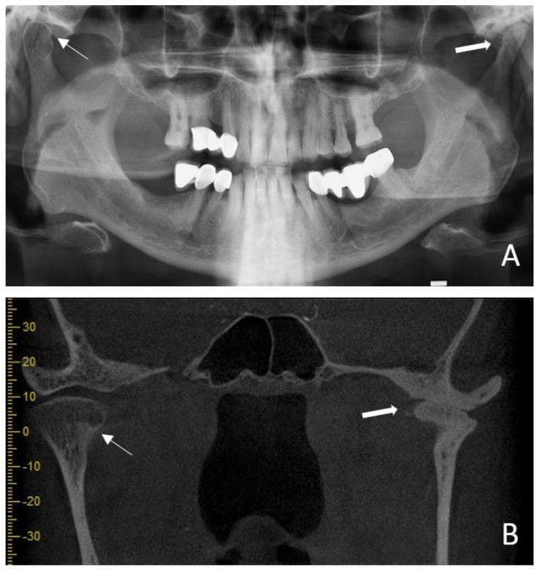 This composite diagnostic image illustrates osseous changes in the temporomandibular joint (TMJ) of a patient with long-standing rheumatoid arthritis. Panel A is a panoramic radiograph (orthopantomogram) showing bilateral condylar involvement. Key features include flattening of the condylar head, a decrease in joint space (thick arrow), and anterior condylar resorption (thin arrow) appearing as localized radiolucency. Panel B provides a coronal cone beam computed tomography (CBCT) section, which offers superior visualization of these degenerative changes. The CBCT reveals significant anterior resorption (thin arrow), multiple small subchondral radiopacities within the condylar head, and signs of bony ankylosis (thick arrow) where the condyle articulates with the temporal bone. These findings are characteristic of advanced inflammatory arthropathy of the TMJ, demonstrating the progressive bone destruction, secondary remodeling, and joint space narrowing associated with chronic systemic rheumatic disease. The imaging serves as a comparison between traditional 2D radiography and 3D cross-sectional imaging for evaluating the extent of maxillofacial pathology.