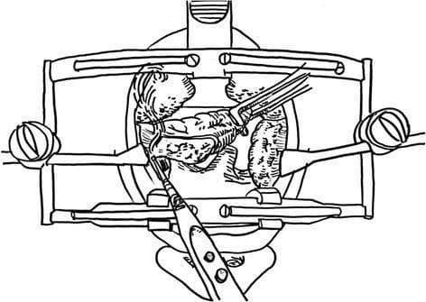 A surgical illustration depicting a tonsillectomy procedure using a monopolar electrocautery technique. The diagram shows an oral cavity held open by a McIvor or Dingman mouth gag retractor, providing optimal visualization of the oropharynx. A palatine tonsil is being retracted medially using curved Kelly clamps, which provide the necessary tension to expose the extracapsular dissection plane. The tip of a monopolar electrocautery pencil is positioned at the junction between the tonsillar capsule and the surrounding pharyngeal musculature, demonstrating the process of surgical dissection. This educational diagram illustrates the key principles of cold and hot dissection tonsillectomy, including proper instrumentation, the importance of medial traction, and the precise identification of the peritonsillar space to minimize bleeding and protect the tonsillar pillars.