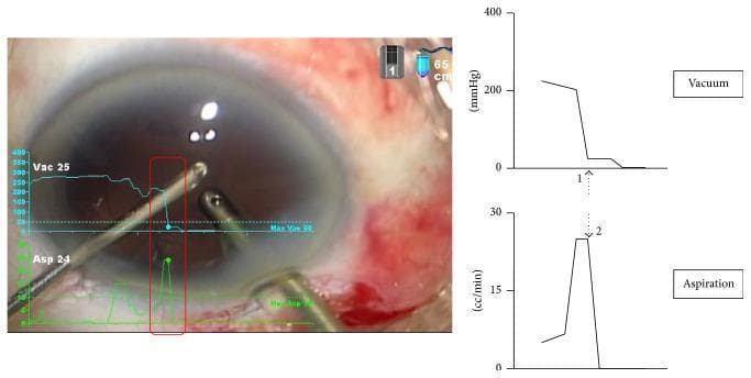 This image is a composite of a clinical photograph and synchronized physiological data graphs representing a cataract surgery complication. The photograph shows the anterior segment of a human eye during bimanual irrigation and aspiration (IA). Two metallic surgical instruments are visible within the anterior chamber; the tip of one instrument is positioned near the posterior capsule. To the right, two line graphs illustrate the real-time fluidics data provided by a Surgical Media Center (SMC). The top graph displays vacuum levels (mmHg, 0–400), showing a sharp decline (arrow 1). The bottom graph displays the aspiration rate (cc/min, 0–30), showing a sudden spike followed by a rapid fall (arrow 2). This inverse relationship—a vacuum drop combined with an abrupt aspiration increase—is characteristic of a post-occlusion surge. This surge resulted in the accidental aspiration and subsequent rupture of the posterior capsule. The clinical relevance is to demonstrate the importance of monitoring fluidic parameters during phacoemulsification to prevent intraoperative complications.