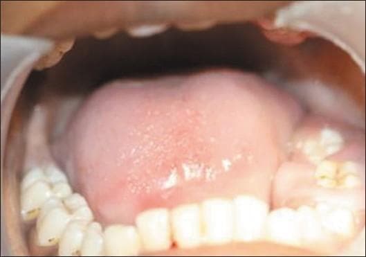 This clinical intraoral photograph demonstrates significant localized gingival hyperplasia on the left side of the mandibular arch. The image shows a bulbous, pale pink, and firm enlargement of the gingival tissue. The overgrowth is most pronounced around the molar region, where the tissue extensively covers both the facial and lingual surfaces of the teeth, leaving only the occlusal surfaces visible. The surface of the hyperplastic tissue appears smooth with no secondary inflammation or significant color change, although the sheer volume of the enlargement distorts the normal contour of the jaw. This presentation is characteristic of idiopathic gingival fibromatosis or drug-induced gingival overgrowth, resulting in pseudo-pockets and clinical obscuration of the crown anatomy. The right side of the mandible appears unaffected, highlighting the unilateral nature of this specific clinical case.