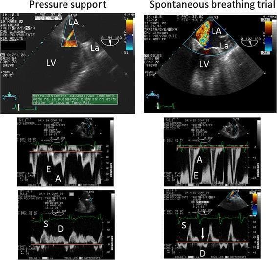 This diagnostic image set displays a side-by-side comparison of transesophageal echocardiography (TEE) findings in a patient with ischemic cardiomyopathy during ventilator weaning. The panels contrast 'Pressure support' (left column) with a 'Spontaneous breathing trial' (right column).
Top row: Color Doppler in a two-chamber view assesses mitral regurgitation (MR). Under pressure support, MR is trivial; during the spontaneous breathing trial, severe MR is visible as a large, turbulent systolic jet filling the left atrium (LA).
Middle row: Pulsed-wave Doppler of mitral inflow. The pressure support state shows an impaired relaxation pattern (E < A), indicating low filling pressures. The spontaneous breathing trial shows a restrictive filling pattern (E > A), indicating a sharp rise in left ventricular (LV) filling pressures.
Bottom row: Pulmonary vein Doppler. Pressure support shows a normal systolic-dominant flow (S wave > D wave). The spontaneous breathing trial reveals a reversed D wave (indicated by the arrow), a hallmark of massive mitral insufficiency and elevated left-sided pressures. This visual series demonstrates weaning-induced cardiac dysfunction secondary to acute ischemic mitral regurgitation.