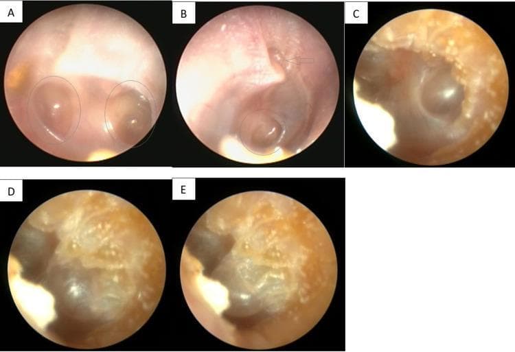 This set of clinical endoscopic images captures the tympanic membrane (TM) and middle ear pathology in a patient with eustachian tube dysfunction. Panel A (Left ear) displays two distinct, concave retraction pockets (circled), indicating prolonged negative middle ear pressure. Panel B (Right ear) shows a dull, opaque TM with a single retraction pocket and a visible pressure equalization tube (PET) insertion site indicated by an arrow. Panels C, D, and E (Left ear) demonstrate clinical progression following weight loss, showing the successful inflation of the retraction pocket during a Valsalva maneuver—a dynamic change that was previously unachievable. This visual sequence illustrates the relationship between anatomical changes, middle ear ventilation, and the management of chronic TM retraction. The images serve as an educational resource for identifying retraction pocket morphology, the positioning of PETs, and evaluating the patency of the eustachian tube via pneumatic or physiological maneuvers.