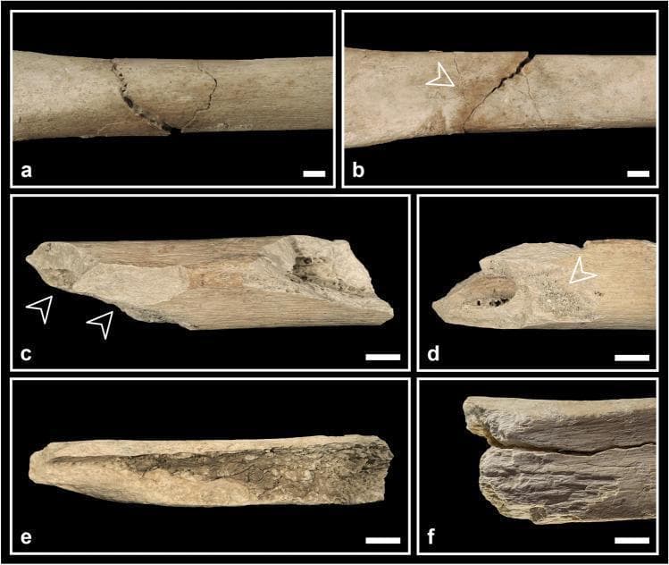 This composite of clinical photographs illustrates various perimortem fracture patterns in human skeletal specimens, specifically the tibia and femur, used for forensic and anthropological analysis. Panels a and b display a classic butterfly fracture on a tibial shaft from anterior and posterior perspectives; a transverse fracture line is visible, with a secondary incomplete fracture line branching off posteriorly (indicated by an arrowhead). Panels c and d show a femur fragment exhibiting spiral fractures and cortical bone spalling (black arrowheads), with panel d highlighting adherent sediments (white arrowhead) within the spalled region. Panel e demonstrates a bone flake with an oval profile, characterized by smooth surfaces and an acute proximal fracture angle, typical of fresh bone breakage. Panel f depicts a tibia specimen showing 'peeling' and a roughened, exfoliated cortical surface. These features are critical for distinguishing between perimortem trauma (occurring at or near the time of death) and postmortem damage, providing insights into injury mechanisms or ritualistic bone processing.