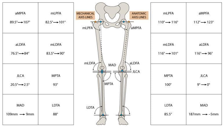 An educational musculoskeletal diagram and comparison chart illustrating lower limb alignment and surgical planning for deformity correction. The central figure displays an anteroposterior skeletal diagram of the pelvis and lower limbs with superimposed mechanical and anatomical axis lines. Key radiological parameters are labeled, including mechanical axis deviation (MAD), joint line convergence angle (JLCA), and various femoral and tibial angles (aMPFA, mLPFA, aLDFA, mLDFA, MPTA, and LDTA). Surrounding the diagram are tables documenting preoperative and postoperative values for each limb, represented by a transition from an initial value to a corrected value (e.g., MAD 109mm to 9mm on the left). The diagram visualizes the intersection of mechanical axes (hip center to ankle center) and anatomical axes (through the shafts) with articular surface tangents. This educational tool is used in orthopedic surgery and physical medicine to evaluate 'windswept' or varus/valgus deformities and to quantify the outcomes of corrective osteotomy.