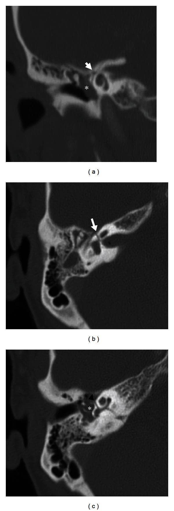 This composite of high-resolution computed tomography (CT) images illustrates a transverse temporal bone fracture, a common cause of traumatic facial nerve injury. The set includes a coronal view (a) and two axial views (b, c). In images (a) and (b), white arrows highlight a transverse fracture line intersecting the labyrinthine segment of the facial nerve canal, which is the narrowest and shortest part of the nerve's course, making it highly susceptible to injury. In axial image (c), a black arrowhead indicates the fracture's extension through the otic capsule and the basal turn of the cochlea, pathology associated with sensorineural hearing loss and vestibular dysfunction. Throughout all three panels, asterisks (*) identify the middle ear cavity, which is opacified by hyperdense material consistent with blood products (hemotympanum). These diagnostic images demonstrate the key radiological findings used to evaluate temporal bone trauma, specifically the relationship between fracture orientation and critical neuro-otologic structures like the facial nerve and inner ear.