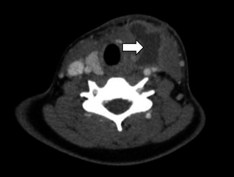 This diagnostic axial CT scan of the neck with contrast demonstrates an ill-defined, heterogeneous lesion in the left paratracheal soft tissue. A white arrow points to the primary pathology: a fourth branchial cleft cyst showing as a hypodense, fluid-filled area with rim enhancement, suggesting inflammation or infection. Key anatomical landmarks visible include the central air-filled trachea (dark circular structure) and the cervical vertebra (bright white structure posterior to the airway). The image captures the characteristic fistulous tract associated with this congenital anomaly, which is seen extending from the paratracheal region toward the left pyriform sinus. The lesion is located medial to the vascular structures of the carotid sheath and lateral to the trachea, illustrating the typical course of a fourth branchial arch remnant. This image is used to teach medical students and radiology residents the diagnostic presentation of a rare branchial cleft anomaly and its anatomical relationship to the upper aerodigestive tract.