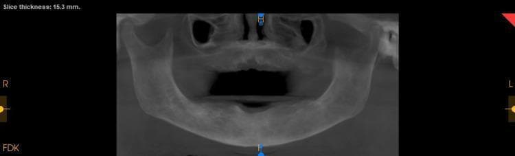 This diagnostic image is a reconstructed panoramic view from a postoperative cone-beam computed tomography (CBCT) scan, with a displayed slice thickness of 15.3 mm. The image provides a comprehensive view of the maxilla and mandible, focusing on the alveolar bone and remaining dentition following surgical intervention for an ossifying fibroma. Key findings include generalized bone loss and a prominent surgical void in the anterior maxilla where the lesion was excised. The trabecular bone throughout the jaw appears more coarse than normal, and the cortical plates show marginal thickening, which are characteristic radiographic features often associated with fibro-osseous conditions or Paget's disease. Multiple teeth are absent consistent with the postoperative state of debridement and extractions. The image is used in dental and oral surgery education to demonstrate postoperative healing, bone density changes in fibro-osseous lesions, and the use of CBCT reconstruction for monitoring surgical outcomes in the maxillofacial region.