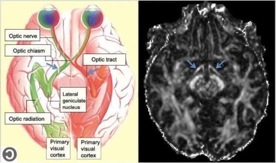 The image consists of two panels illustrating the human visual pathway. The left panel is an anatomical diagram showing a superior view of the brain with the visual system highlighted. It labels the eyes, optic nerves, optic chiasm, optic tracts (indicated by blue arrows), lateral geniculate nucleus (LGN), optic radiations, and primary visual cortex in the occipital lobes. Color-coded pathways demonstrate the decussation of nasal retinal fibers at the optic chiasm and the ipsilateral projection of temporal fibers. The right panel is a diagnostic image featuring an axial slice of a Diffusion Tensor Imaging (DTI) Fractional Anisotropy (FA) map at the level of the midbrain and optic tracts. On this grayscale map, white matter tracts with high anisotropy appear hyperintense (bright). Blue arrows specifically point to the bilateral optic tracts as they exit the optic chiasm and course posteriorly toward the LGN. This dual-panel presentation serves to correlate schematic anatomical knowledge with clinical neuroimaging used to assess white matter integrity in pathological conditions affecting the visual pathways.