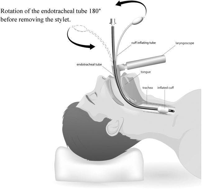 This medical illustration demonstrates the 'ETT 180-degree rotation' intubation technique in a sagittal view of a patient in the supine position. The diagram shows an endotracheal tube (ETT) with an internal stylet passing through the oral cavity, over the tongue, and into the trachea. A laryngoscope is depicted positioned to displace the tongue for glottic visualization. The primary educational focus is the clockwise rotation of the ETT by 180 degrees once the distal tip, featuring an inflated cuff, passes the vocal cords but before the stylet is removed. A curved arrow illustrates this rotational maneuver. This specific airway management technique is designed to align the ETT and stylet with the posterior angulation of the trachea, thereby minimizing trauma to the anterior tracheal wall during advancement. Labeled structures include the endotracheal tube, stylet-loaded cuff inflating tube, laryngoscope, tongue, trachea, and inflated cuff. This resource is relevant for anesthesiology and emergency medicine training regarding optimized endotracheal intubation maneuvers.