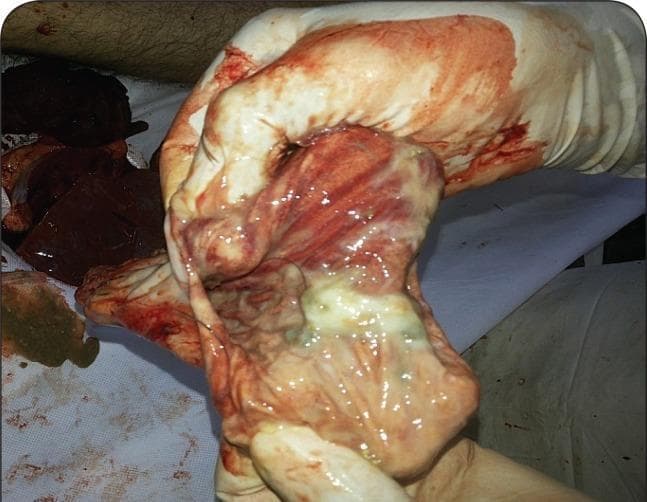 This clinical photograph shows a gross pathological specimen of the human stomach mucosa, likely taken during a post-mortem or surgical examination. The gastric lining exhibits intense, diffuse hyperemia and congestion, characterized by a deep red coloration. There are visible areas of intramural hemorrhage and petechial spots across the mucosal surface. The tissue has a shiny, edematous appearance with prominent rugae. A focal area of greenish-yellow mucoid substance is present, suggesting potential chemical irritation or altered gastric contents. This image serves as an educational example of severe gastrointestinal mucosal injury, often associated with acute gastritis or toxic ingestion, such as aluminium phosphide poisoning. The specimen is being handled by a person wearing white latex gloves in a clinical or forensic setting.
