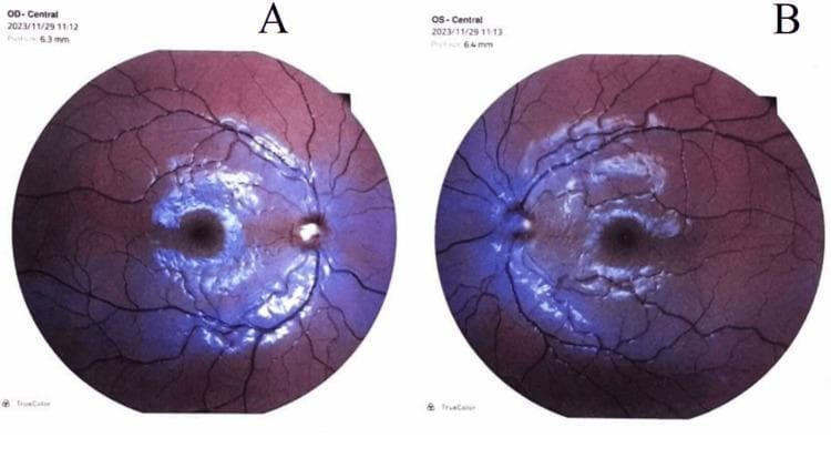 This diagnostic image displays bilateral fundus photographs of the right eye (OD, labeled A) and left eye (OS, labeled B). The images demonstrate severe bilateral papilledema, characterized by significant optic disc swelling with blurred, indistinct disc margins and a peripapillary halo. In both eyes, the optic nerves appear elevated and hyperemic, with a loss of the physiological cup. The retinal vasculature exhibits marked tortuosity and engorgement, with several vessels becoming obscured as they cross the disc margin due to the overlying edema. The surrounding retinal tissue shows evidence of compromised perfusion, with a general hyperemic hue and a lack of clarity in the macula and peripapillary region. These visual findings are consistent with Stage 4 papilledema, often associated with increased intracranial pressure. The modality is fundoscopy (retinal imaging), serving as a critical educational tool for identifying neuro-ophthalmological signs of intracranial hypertension.