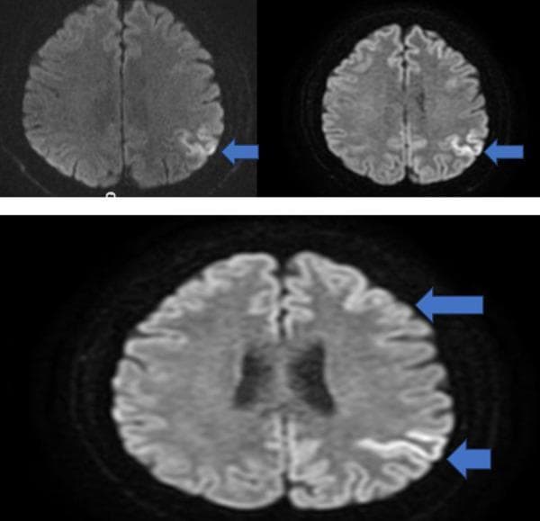 This diagnostic image set consists of axial Diffusion-Weighted Imaging (DWI) brain MRI scans demonstrating focal cortical diffusion restriction. The primary pathology is localized to the left parietal lobe, specifically within the cortical structures in the posterior neighborhood of the central sulcus. The affected areas exhibit a characteristic hyperintense signal (bright appearance) on the DWI sequences, indicated by blue arrows. This pattern, often referred to as 'cortical ribboning,' is highly significant in clinical neurology. While such findings can be associated with acute-subacute ischemic stroke, when present in a patient with rapidly progressive cognitive decline and myoclonus, it is a hallmark diagnostic feature of Creutzfeldt-Jakob Disease (CJD). The image highlights the anatomical distribution of the restricted diffusion, illustrating its confinement to the gray matter of the parietal cortex without initial deeper white matter involvement. It serves as a critical educational example of neuroimaging markers for prion diseases and the differential diagnosis of focal neurological deficits.