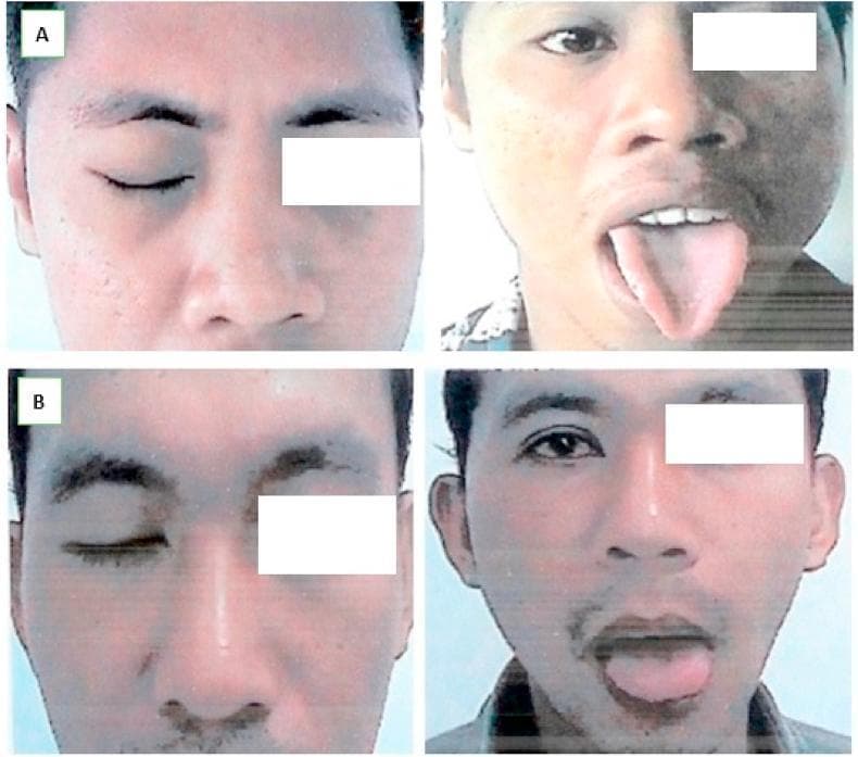 Clinical photograph showing two male patients (A and B) post-surgical reanimation for facial nerve palsy, evaluated using the House-Brackmann (HB) Scale. Each patient is shown in two views: one demonstrating eye closure and one demonstrating tongue protrusion. Patient A (top row) displays complete eye closure on the affected side and successful tongue protrusion with slight deviation, indicating progress after a split hypoglossal-facial anastomosis. Patient B (bottom row) likewise demonstrates functional eye closure and central tongue protrusion. The clinical objective shown is the assessment of motor function recovery in the facial and hypoglossal nerve distributions. Both cases illustrate HB Grade I results at 10 months post-operation, characterized by normal facial function in all areas. The images emphasize the success of nerve graft techniques in restoring facial symmetry and voluntary muscle control following skull base fractures.