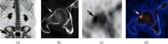 This composite figure presents clinical imaging of a patient with prostate cancer, focusing on bone metastasis evaluation. Image (A) is a whole-body radionuclide bone scan (PET/CT) in the anterior view, showing tracer uptake in the axial skeleton, kidneys, and bladder. A red box and black arrow highlight an area of interest in the right hip region. Image (B) provides a magnified CT scan of the right femoral head, revealing subchondral sclerosis, mixed dense foci, and internal cystic changes consistent with a subchondral bone cyst. Image (C) is a corresponding PET scan showing a focal area of increased radioactive tracer uptake at the same anatomical site, indicating high metabolic activity or bone turnover. Image (D) is a fused PET/CT image, co-registering the metabolic ‘hot spot’ with the structural lesions identified on CT. These findings are characteristic of osteoblastic and osteolytic changes associated with metastatic prostate cancer. The images demonstrate the clinical utility of multi-modal imaging in identifying the location, morphology, and metabolic significance of skeletal lesions.