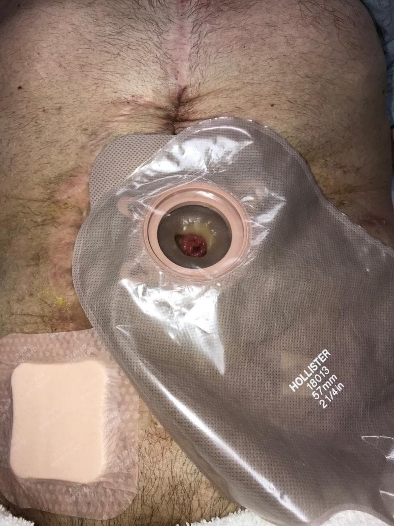 This clinical photograph displays a post-operative adult abdomen showing a healing surgical wound and stoma management. A prominent midline vertical laparotomy scar is visible, extending from the epigastrium toward the umbilical region, indicating a previous major abdominal intervention. Centered on the mid-abdomen is a transparent Hollister (57mm) ostomy appliance containing a visible reddish, fleshy stoma, likely an ileostomy or colostomy, surrounded by some yellowish effluent. To the lower left of the ostomy bag, a square, beige hydrocolloid or foam adhesive dressing is applied over a secondary wound site or skin irritation area. The peristomal skin and surrounding abdominal surface show signs of uneven pigmentation, thinning, and mild erythema, consistent with chronic wound management and previous use of negative pressure wound therapy (NPWT). This image illustrates advanced wound and fistula care in a patient with a history of complex Crohn's disease and abdominal sepsis, demonstrating the transition to post-acute home care management.