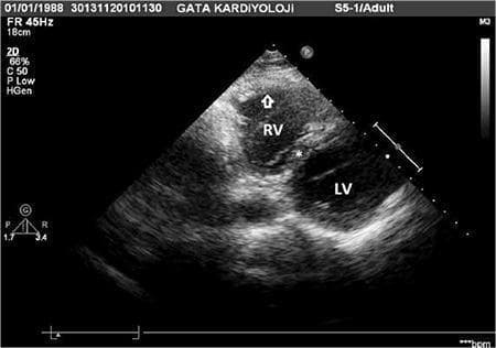 A 2D transthoracic echocardiogram in a left parasternal, basal, short-axis projection illustrating significant right-heart pathology. The image displays a dilated and hypertrophied right ventricle (RV) compared to the left ventricle (LV). An arrow points to the thickened RV free wall, noted to be 11.4 mm, indicating right ventricular hypertrophy. The RV chamber is prominently enlarged with a measured area of 18.1 cm², consistent with volume or pressure overload. The interventricular septum (marked with an asterisk) appears displaced, suggesting altered ventricular hemodynamics. The left ventricle (LV) is labeled in its respective inferior-right position within the ultrasound sector. This diagnostic imaging provides visual evidence of chronic right-sided heart strain, often seen in congenital heart conditions such as Scimitar syndrome or pulmonary hypertension. The modality is an adult echocardiographic study used to evaluate cardiac chamber dimensions, wall thickness, and spatial relationships between the ventricles.