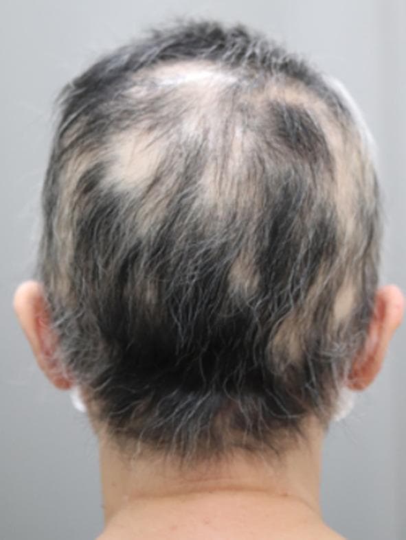 Clinical photograph showing the posterior view of a human scalp and neck, primarily illustrating Alopecia areata (AA). The image captures the crown, occipital region, and nape. Multiple non-scarring, circumscribed patches of hair loss are visible, varying in size from 1 to 3 centimeters. The affected scalp within these patches appears smooth, pale, and lacks visible inflammation, scaling, or scarring. Short, fine hairs are visible within some of the patches, consistent with the clinical stage of hair regrowth. The surrounding terminal hair is salt-and-pepper in color and appears normal in texture. This visual evidence supports the diagnosis of multifocal alopecia areata and demonstrates the progress of hair follicle regeneration following treatment, specifically 6 months post-thymectomy in the context of paraneoplastic autoimmune phenomena. The image serves as a clinical reference for dermatological examination and monitoring of autoimmune-related hair loss.