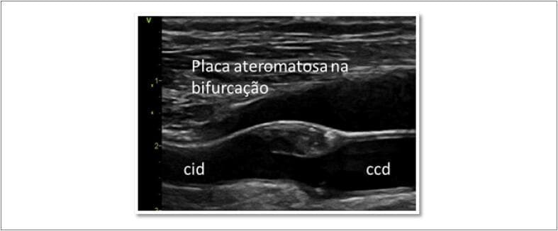 This diagnostic image is a B-mode ultrasound scan in longitudinal view of the right carotid artery. It demonstrates an atherosclerotic plaque located at the carotid bifurcation. The visual highlights a heterogeneous, eccentrically positioned plaque protruding into the vessel lumen from the posterior wall. The plaque exhibits mixed echogenicity, with hypoechoic areas suggesting a lipid-rich core or intraplaque hemorrhage, and hyperechoic regions likely representing fibrous tissue or focal calcification. Annotations include 'ccd' (common carotid artery right) and 'cid' (internal carotid artery right), indicating the anatomical transition zone. The image illustrates significant luminal narrowing, consistent with moderate carotid stenosis. This clinical photograph is used in cardiovascular medicine to assess stroke risk, evaluate intima-media thickness, and monitor progressive atherosclerosis or radiation-induced actinic arteritis.