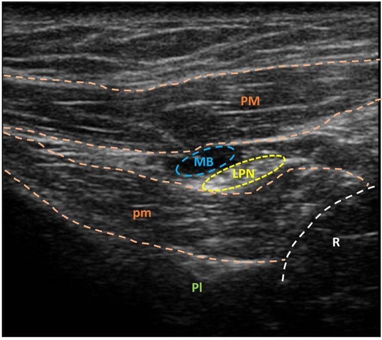 This diagnostic image is a high-frequency ultrasound of the subclavicular region, demonstrating ultrasound-guided needle marking of the lateral pectoral nerve (LPN). The cross-sectional view shows layered musculoskeletal anatomy: the superficial pectoralis major muscle (PM) and the deeper pectoralis minor muscle (pm). The LPN is visualized within the fascial plane between these two muscles, highlighted by a yellow dashed circle. Adjacent to the nerve, a localized hypoechoic area (MB, blue dashed circle) represents injected methylene blue used for intraoperative identification. In the deep field, the pleura (Pl) appears as a hyperechoic line, and a rib (R) is visible as a curved, hyperechoic structure with posterior acoustic shadowing. This visualization is clinically significant for regional anesthesia, spasticity management via selective peripheral neurectomy, and identifying anatomical landmarks for thoracic wall procedures.