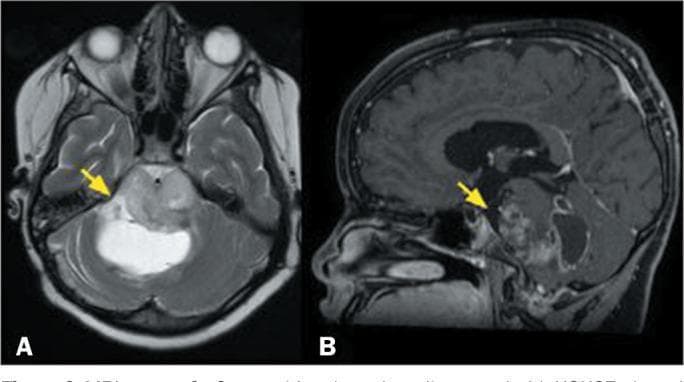 This diagnostic imaging composite displays two magnetic resonance imaging (MRI) sequences of the brain in a pediatric patient, illustrating a diffuse midline glioma affecting the brainstem. Image A is an axial T2-weighted sequence showing an expansile, infiltrative lesion located in the pons. The lesion demonstrates a heterogeneous signal intensity, with hyperintense focal areas (yellow arrow) indicative of cystic components or internal necrosis. The mass effect is evident as it expands the pontine contours. Image B is a sagittal, fat-saturated, T1-weighted sequence with gadolinium contrast enhancement. It reveals the solid portions of the tumor exhibit irregular, heterogeneous enhancement (yellow arrow), suggesting varying vascularity and blood-brain barrier disruption within the mass. The clinical presentation and imaging features are characteristic of a high-grade pediatric-type diffuse midline glioma, specifically the H3K27-altered molecular subtype. This case highlights the typical neuroradiological appearance of aggressive midline gliomas in children, focusing on expansile growth, signal heterogeneity, and variable contrast uptake.