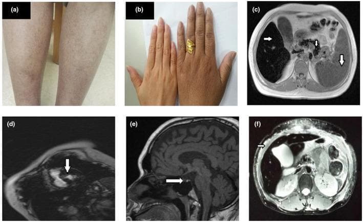 A multi-panel figure illustrating the clinical and radiological manifestations of juvenile hereditary hemochromatosis. Panels (a) and (b) are clinical photographs showing focal skin hyperpigmentation: (a) demonstrates speckled, slight pigmentation on the anterior tibia of the lower limbs, while (b) shows more diffuse, uniform dark pigmentation on the left hand compared to the right. Panels (c) through (f) display MRI diagnostic images highlighting systemic iron overload. In (c) and (f), axial abdominal MRI scans reveal significantly reduced T2 signal intensity in the liver and spleen (indicated by white arrows), appearing as 'black matter lesions' characteristic of excessive iron deposition. Panel (d) shows an axial cardiac MRI with low myocardial signal (arrow), indicating cardiac iron involvement. Panel (e) is a sagittal cranial MRI demonstrating decreased signal intensity within the pituitary gland (arrow). These visual findings collectively teach the multi-organ impact of iron overload, affecting the skin, liver, heart, and endocrine system in a clinical syndrome associated with HAMP gene mutations.