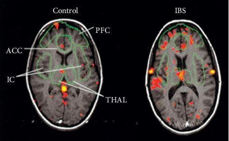This Comparison Chart features two axial functional magnetic resonance imaging (fMRI) brain scans demonstrating differences in cerebral activation between a control subject and a patient with Irritable Bowel Syndrome (IBS) during visceral nociceptive stimulation. The images use a colorimetric heat map (red/yellow) overlaid on anatomical T1-weighted templates to represent regional cerebral blood flow and neuronal activity. Key neuroanatomical regions are labeled with green outlines, including the Prefrontal Cortex (PFC), Anterior Cingulate Cortex (ACC), Insular Cortex (IC), and Thalamus (THAL). The IBS patient scan shows significantly increased intensity and broader spatial distribution of activation compared to the control subject. Specific hyperactivation is visible in the THAL and ACC, regions associated with the transmission and integration of pain signals. The PFC also demonstrates markedly higher activation in the IBS patient. This diagnostic imaging comparison illustrates the pathophysiology of visceral hypersensitivity and central sensitization in functional gastrointestinal disorders, highlighting the altered central processing of visceral pain.