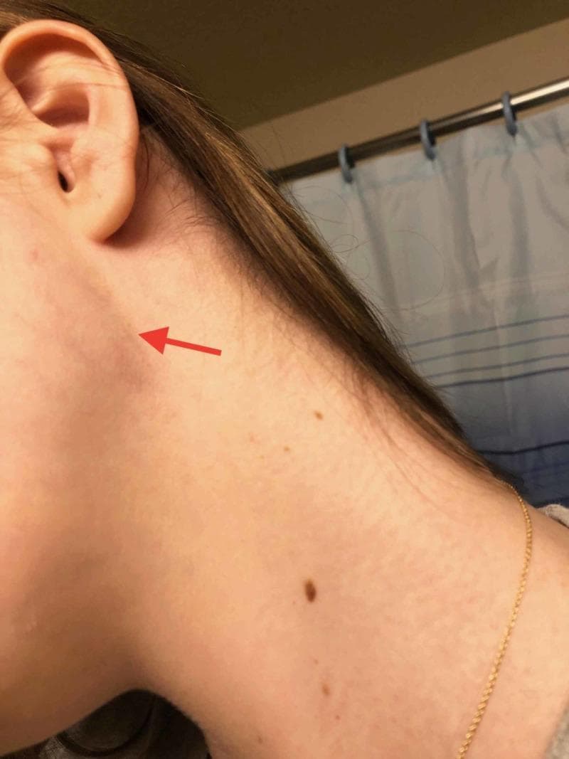 Clinical photograph of a patient's left lateral neck showing a subtle, focal swelling in the infra-auricular region. A red arrow points to a palpable mass approximately 1-2 cm in diameter, located inferior and slightly anterior to the lobule of the ear, overlying the sternocleidomastoid muscle area. The overlying skin is intact with no visible erythema, ecchymosis, or inflammatory changes, though several benign-appearing nevi are scattered on the neck surface. Anatomically, this presentation is consistent with anterior cervical lymphadenopathy. In a clinical context involving malaise and fever, such a finding may represent reactive lymphadenopathy associated with infectious processes like Infectious Mononucleosis (EBV) or other systemic infections. The image serves as a clinical example of localized neck masses and the surface anatomy of cervical lymph node stations.