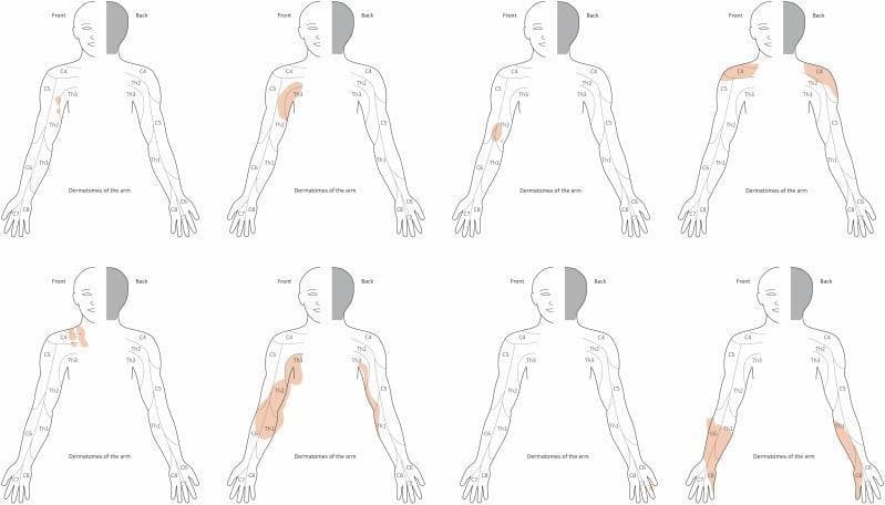 This medical illustration consists of eight schematic drawings depicting dermatomal distribution of the upper limb and hand, used to map the extent of plexiform neurofibromas (PNF). Each figure shows a frontal and dorsal (back) outline of a human torso and right arm. The dermatomes are labeled C4 through C8 and Th1 through Th3, illustrating the sensory innervation pathways from the shoulder to the fingertips. Areas of tumor involvement—representing either diffuse cutaneous neurofibroma or subcutaneous nodular PNF—are shaded in light orange/brown. The diagrams demonstrate the variable presentation of Neurofibromatosis type 1 (NF1), ranging from small, localized lesions restricted to a single dermatome (e.g., C5 or Th2) to large, confluent masses that cross multiple dermatomal boundaries and alter the anatomical contour of the limb. This visual tool aids in the clinical assessment and surgical planning of PNF by correlating physical tumor topography with spinal nerve segments, highlighting that tumor expansion often occurs independently of strict anatomical dermatomal borders.