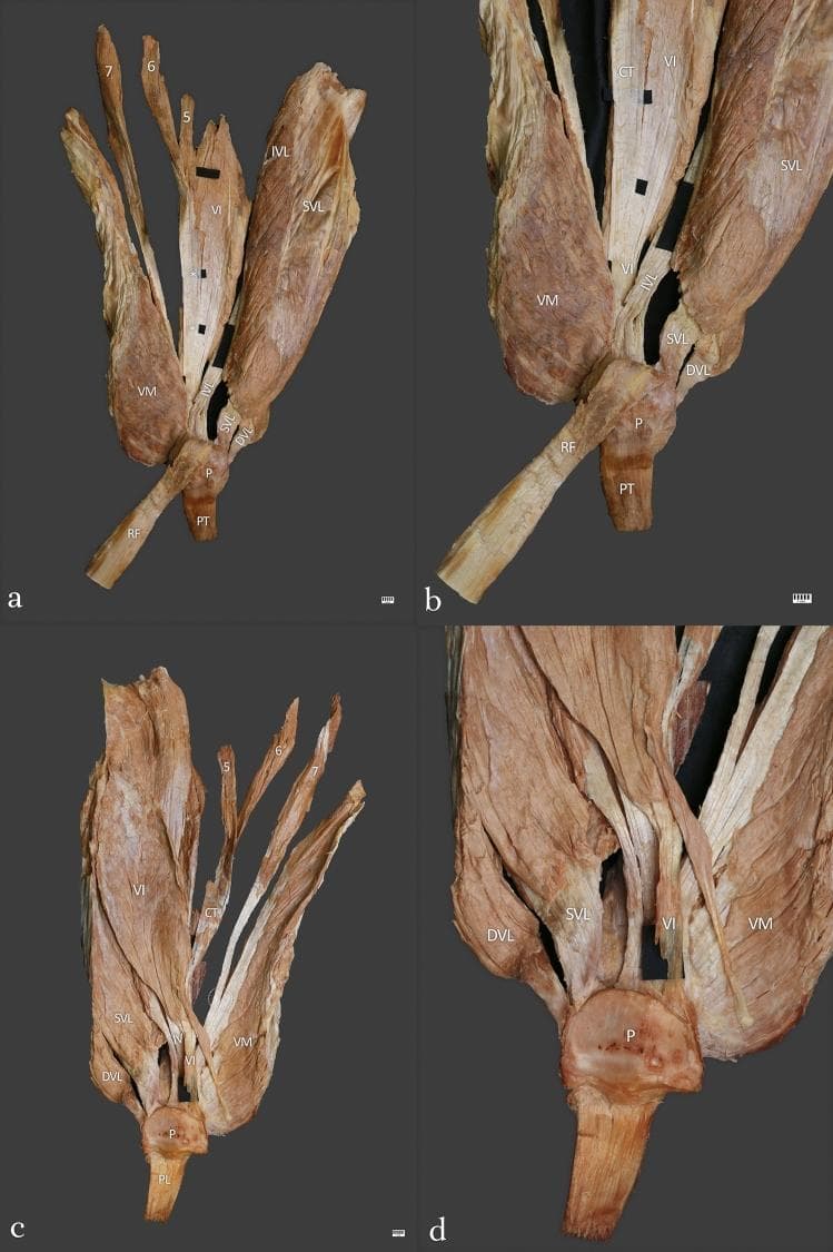 This set of clinical photographs shows a detailed anatomical dissection of a Type IV quadriceps femoris complex from a left-sided human specimen. Four views are provided: wide anterior (a), enlarged anterior (b), wide posterior (c), and enlarged posterior (d). The images demonstrate the multi-layered and multi-headed structure of the quadriceps tendon. Key anatomical structures labeled include the rectus femoris (RF), vastus medialis (VM), and three distinct parts of the vastus lateralis: superficial (SVL), intermediate (IVL), and deep (DVL). The vastus intermedius (VI) is shown in the central deep layer. Notably, the specimen illustrates accessory heads numbered 5, 6, and 7, highlighting the morphological variability of the muscle. A common tendon (CT) serves as a fusion point for the fifth and sixth heads. The distal attachment site includes the patella (P) and patellar tendon (PT). This educational visual is intended for advanced musculoskeletal anatomy and surgical planning, illustrating the complex stratification and tendinous architecture of the knee extensors.