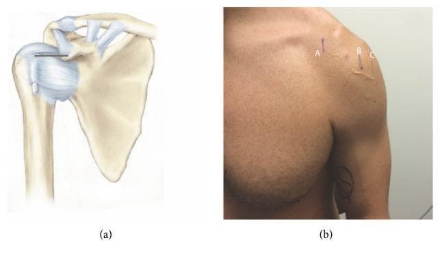 This composite educational graphic focuses on shoulder anatomy and surface landmark localization for clinical procedures. Figure (a) is an anatomical diagram of the right shoulder joint depicting the scapula, clavicle, and proximal humerus. It highlights the coracoclavicular and acromioclavicular ligaments, as well as the glenohumeral capsule. A horizontal black line illustrates the measurement distance between the coracoid process and the intertubercular (bicipital) groove. Figure (b) is a clinical photograph showing the anterior aspect of a human male's left shoulder with surface markings. Vertical skin markings labeled A, B, and C correspond to the underlying anatomy: (A) represents the coracoid process, (B) marks the intertubercular groove at 0° of external rotation, and (C) marks the same groove at 45° of external rotation. Visible ultrasound gel near markings B and C suggests that these points were localized using musculoskeletal ultrasound. This material is designed to teach clinical localization of the long head of the biceps tendon relative to fixed bony landmarks for diagnostic or therapeutic injections.