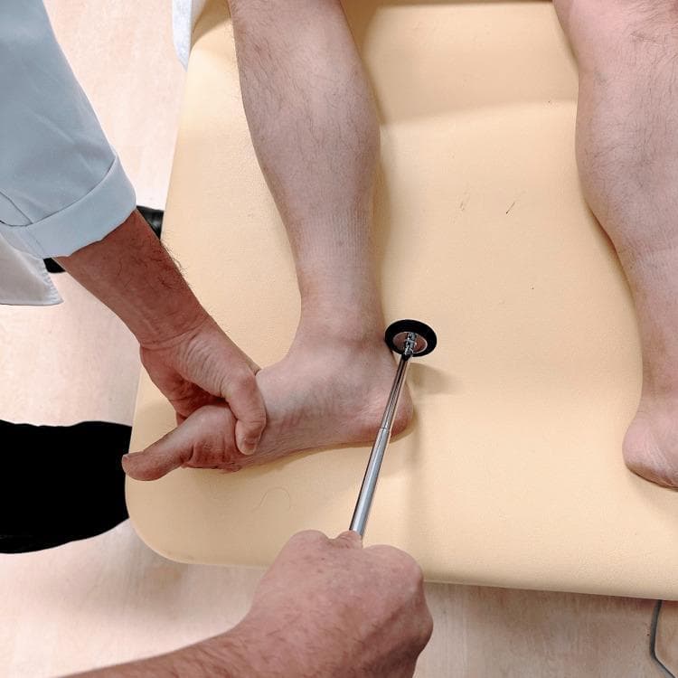Clinical photograph demonstrating the technique for eliciting the Achilles tendon reflex (ankle jerk) in a patient positioned supine. The patient's lower extremity is placed in a 'frog-leg' position, characterized by hip abduction, external rotation, and knee flexion. The examiner’s non-dominant hand is shown providing gentle dorsiflexion at the metatarsal area to stretch the Achilles tendon, ensuring the gastrocnemius-soleus complex is under slight tension. The dominant hand holds a Taylor-style reflex hammer, with the rubber head positioned to strike the Achilles tendon just above its insertion on the calcaneus. This clinical maneuver evaluates the S1 and S2 nerve roots and the integrity of the tibial nerve. The photograph serves as an educational guide for neurological physical examination techniques, specifically for patients who cannot easily sit or kneel for reflex testing.