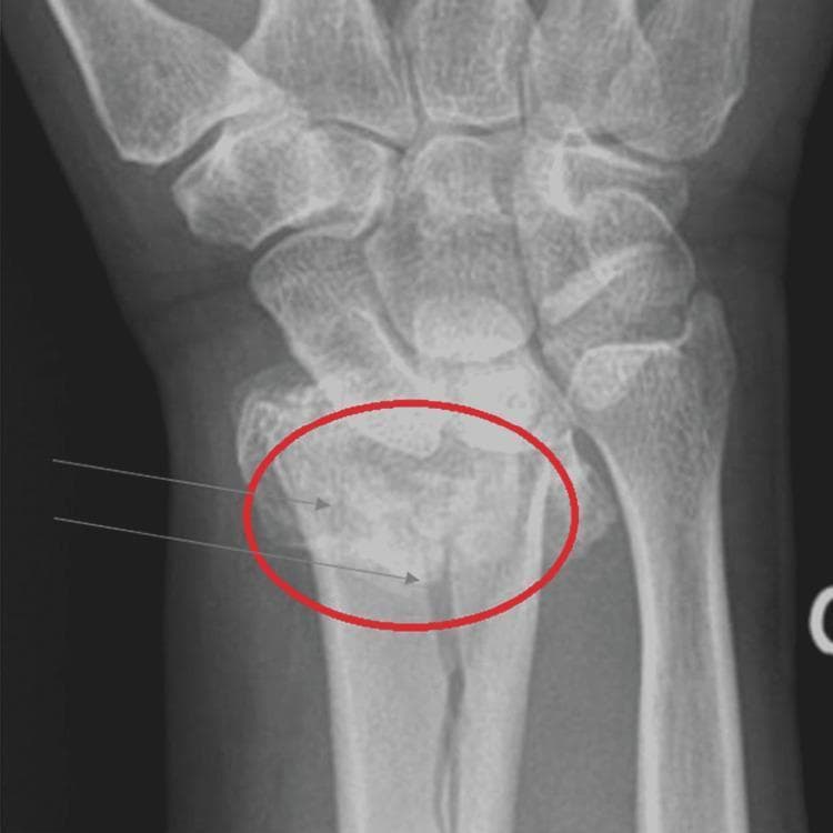This medical diagnostic image is an anteroposterior (AP) x-ray radiograph of the distal forearm and wrist, demonstrating a Colles fracture. The radiograph depicts the distal radius, distal ulna, carpal bones, and proximal metacarpals. A red circle and grey arrows highlight a transverse fracture involving the distal radial metaphysis. Key visual findings include bony discontinuity with classic dorsal (posterior) displacement and impaction of the distal radial fragment, characteristic of a fall on an outstretched hand (FOOSH) injury. The distal ulna appears intact in this view, though some radial shortening may be present due to the fracture's impaction. The surrounding soft tissues show generalized swelling. This image serves as a clinical teaching tool for identifying common orthopaedic fractures, particularly in the context of underlying metabolic bone disease such as osteoporosis, as indicated by the cortical thinning visible in the long bones.
