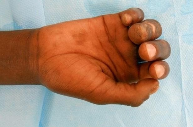 This clinical photograph displays a right hand in a partially flexed position, demonstrating sequelae of an ulnar nerve palsy. The hand shows a characteristic 'claw hand' deformity (main en griffe), particularly affecting the 4th and 5th digits, which exhibit flexion at the interphalangeal joints and a limitation in extension. The skin on the dorsal and palmar surfaces appears indurated with areas of hyperpigmentation and darker macules, while the distal fingertips of the 4th and 5th digits show hypopigmented changes. This presentation is consistent with chronic neurological damage from leprosy (Hansen's disease). The index finger remains more extended, and the third finger shows partial flexibility following rehabilitation. Educational value lies in the visual demonstration of ulnar nerve paralysis, the associated intrinsic muscle wasting, and the integumentary changes secondary to chronic neuropathic disease.