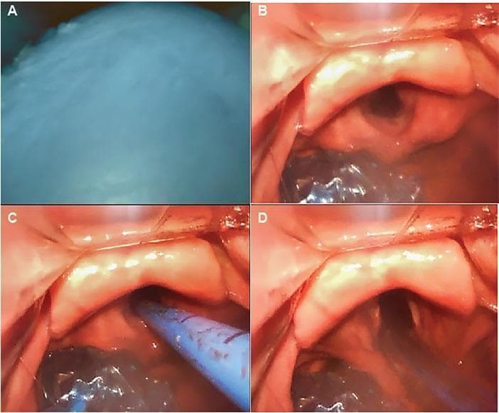 This sequence of four endoscopic images (A-D) demonstrates a Seldinger-style exchange of a King LT extraglottic device for a definitive tracheal tube under video laryngoscopy. Panel A shows the initial view of the inflated, opaque oropharyngeal balloon of the King LT obscuring the laryngeal inlet. Panel B illustrates the glottic view following balloon deflation and blade advancement into the vallecula, clearly revealing the epiglottis, arytenoid cartilages, and vocal cords. Panel C shows the insertion of a blue tracheal introducer (bougie) through the vocal cords into the trachea. Panel D depicts the final stage of advancing a cuffed endotracheal tube over the bougie into the airway. This clinical sequence provides an educational protocol for emergency airway management, specifically addressing the transition from supraglottic ventilation to endotracheal intubation in a controlled manner.