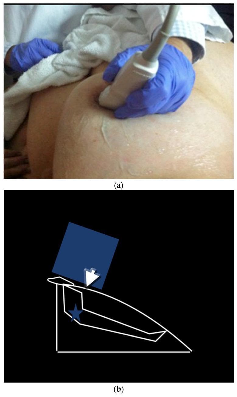 This composite educational resource illustrates the 'peripheral compression technique' for breast ultrasound, designed to improve visualization of the peripheral segments of retroareolar ducts. (a) Clinical photograph: A medical professional, wearing blue nitrile gloves, applies an ultrasound transducer to the breast of a supine patient. The probe is angled and positioned to apply pressure at the edge of the areola. (b) Anatomical diagram: A schematic representation of the maneuver showing the transducer (blue rectangle) applying a downward vector of force (white arrow). This compression displaces the nipple and flattens the underlying ductal structures (outlined in white), making the beam perpendicular to the duct for better resolution. A star marks the anatomical target within the retroareolar segment. This technique is clinically significant in breast imaging for overcoming the acoustic shadowing and anatomical irregularities inherent to the nipple-areolar complex, facilitating the detection of intraductal lesions or ductal ectasia.