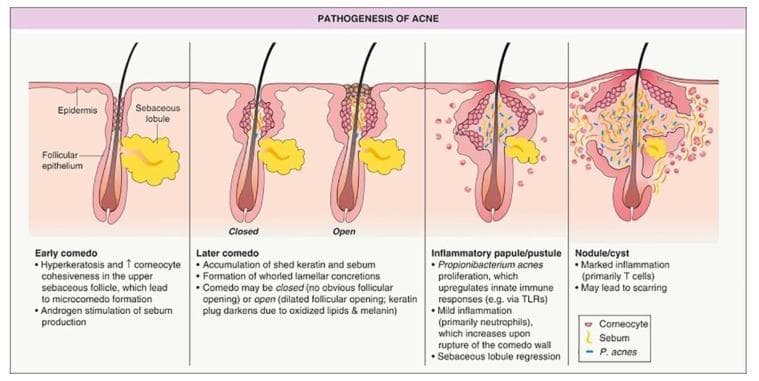 A medical illustrative diagram titled 'PATHOGENESIS OF ACNE' depicting the longitudinal progression of acne vulgaris within a pilosebaceous unit. The diagram is divided into five sequential stages: 1) Early comedo: Shows hyperkeratosis and androgen-stimulated sebum production. 2) Later comedo (Closed): Illustrates a 'whitehead' with a keratin and sebum plug beneath the epidermis. 3) Later comedo (Open): Depicts a 'blackhead' with a dilated follicular opening and darkened keratin plug. 4) Inflammatory papule/pustule: Shows Propionibacterium acnes proliferation, neutrophil infiltration, and rupture of the comedo wall leading to sebaceous lobule regression. 5) Nodule/cyst: Demonstrates marked T-cell inflammation and deep tissue involvement with potential for scarring. Key anatomical labels include the epidermis, follicular epithelium, and sebaceous lobule. A legend identifies visual representations of corneocytes, sebum, and P. acnes. This diagram serves as a primary educational resource for understanding the transition from non-inflammatory microcomedones to severe inflammatory acne lesions.