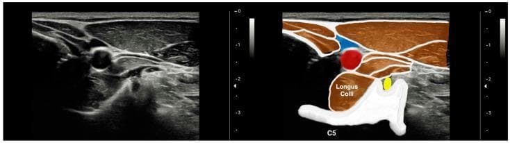 This diagnostic ultrasound image presents a cross-sectional view of the anterior neck anatomy at the level of the fifth cervical vertebra (C5), consisting of an original grayscale sonogram alongside a color-coded annotated duplicate. The image highlights the musculoskeletal and vascular relationships crucial for ultrasound-guided procedures. Centrally, the longus colli muscle is depicted as a hypoechoic, spindle-shaped structure positioned anterior to the hyperechoic vertebral body of C5. Superolateral to the longus colli, the common carotid artery (highlighted in red) appears as a non-compressible, circular, anechoic structure. The internal jugular vein (highlighted in blue) is visible superficial and lateral to the carotid artery, characterized by an oval, compressible anechoic lumen. The yellow annotation identifies the C5 nerve root residing within the transverse process groove. The image illustrates clear fascial planes separating the prevertebral muscles from the carotid sheath and superficial sternocleidomastoid muscle, serving as an educational reference for cervical regional anesthesia and soft tissue assessment.