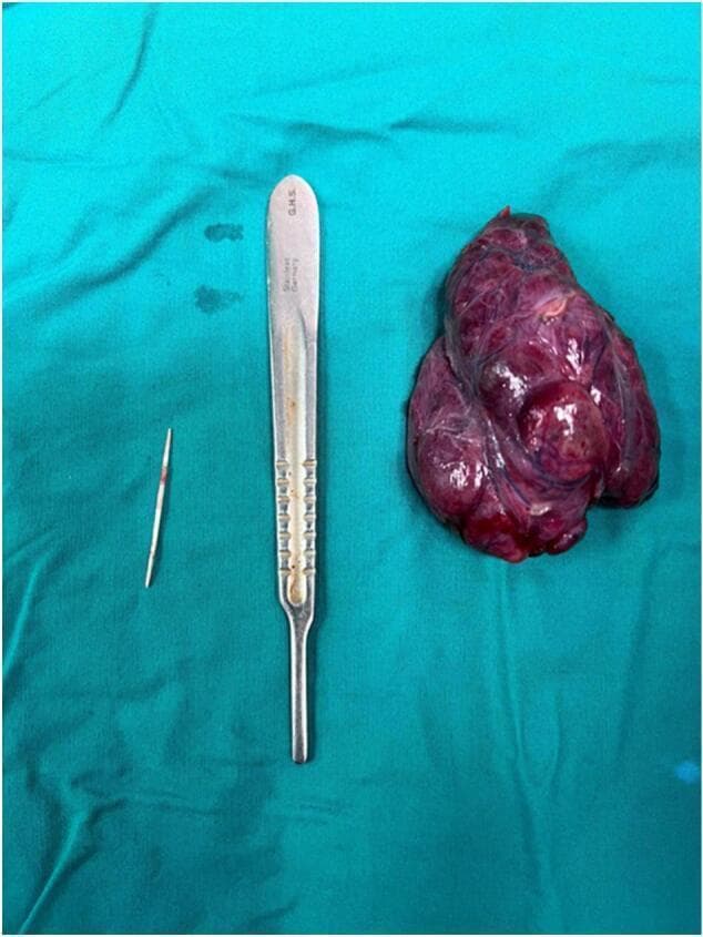 This clinical photograph shows a gross specimen comparison following a surgical neck exploration and hemithyroidectomy. Placed on a green surgical drape are three items: an excised tissue mass, a metal scalpel handle for scale, and a foreign body. The tissue specimen is a left thyroid lobe, appearing as a lobulated, deep red-to-purple mass with an irregular, nodular surface texture consistent with a multinodular goiter or highly vascularized tissue. To the left of the scalpel handle is the offending foreign body: a slender, elongated, pointed object (identified as a fishbone). The fishbone is off-white and translucent with minor blood staining. It measures significantly less than half the length of the scalpel blade. This image demonstrates a rare clinical scenario where an ingested foreign body migrated from the hypopharynx to become lodged within the thyroid parenchyma, necessitating surgical intervention to prevent further inflammatory reaction or vascular injury. It serves as an educational example of aerodigestive tract foreign body complications and thyroid surgical pathology.
