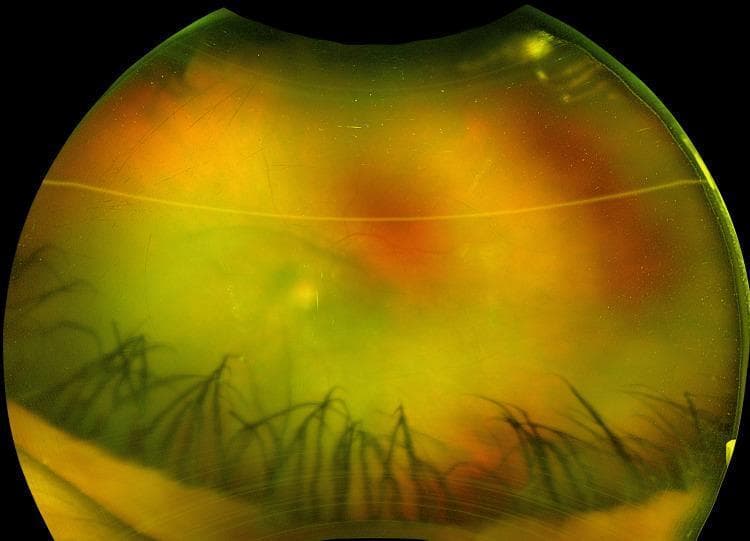 This clinical photograph displays a wide-field view of the left eye, illustrating findings consistent with acute anterior uveitis. The primary pathology is visible within the anterior chamber, characterized by a generalized haziness indicative of a 1+ aqueous flare (protein exudation) and a mottled, cellular appearance corresponding to 2+ anterior chamber cells. The view of the posterior segment is significantly obscured by this inflammatory activity. Notably, the iris demonstrates structural complications in the form of posterior synechiae, visible as dark, linear fibrous adhesions tethering the iris to the underlying lens. These adhesions result in an irregular pupillary margin and contribute to the secluded appearance of the pupil. The overall yellow-orange reflex is hazy due to the presence of both cellular debris and proteinaceous material suspended in the aqueous humor. This image serves as a pedagogical tool for recognizing active ocular inflammation and its structural sequelae, often associated with systemic conditions such as secondary syphilis or other inflammatory etiologies.