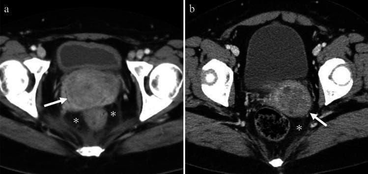 This figure presents two axial contrast-enhanced CT scans of the female pelvis demonstrating imaging features of cervicitis.
Image A illustrates acute cervicitis in a patient with lower abdominal pain. Key findings include an enlarged and edematous uterine cervix (white arrow) exhibiting prominent enhancement. Associated inflammatory changes are visible in the surrounding tissue, specifically fat stranding within the parametrium and perirectal spaces (indicated by asterisks).
Image B demonstrates cystic cervicitis. The uterine cervix contains multiple small, round cystic lesions (white arrow) characterized by heterogeneous attenuation, which can be seen in the context of hemorrhage or infected mucoid material. There is also a slight haziness of the adjacent pelvic fat (asterisk), reflecting localized inflammation.
These images serve as educational examples of how pelvic inflammatory disease (PID) can manifest in the cervix on cross-sectional imaging, highlighting cervical edema, cystic transformation, and secondary infiltration of the surrounding pelvic fat planes.